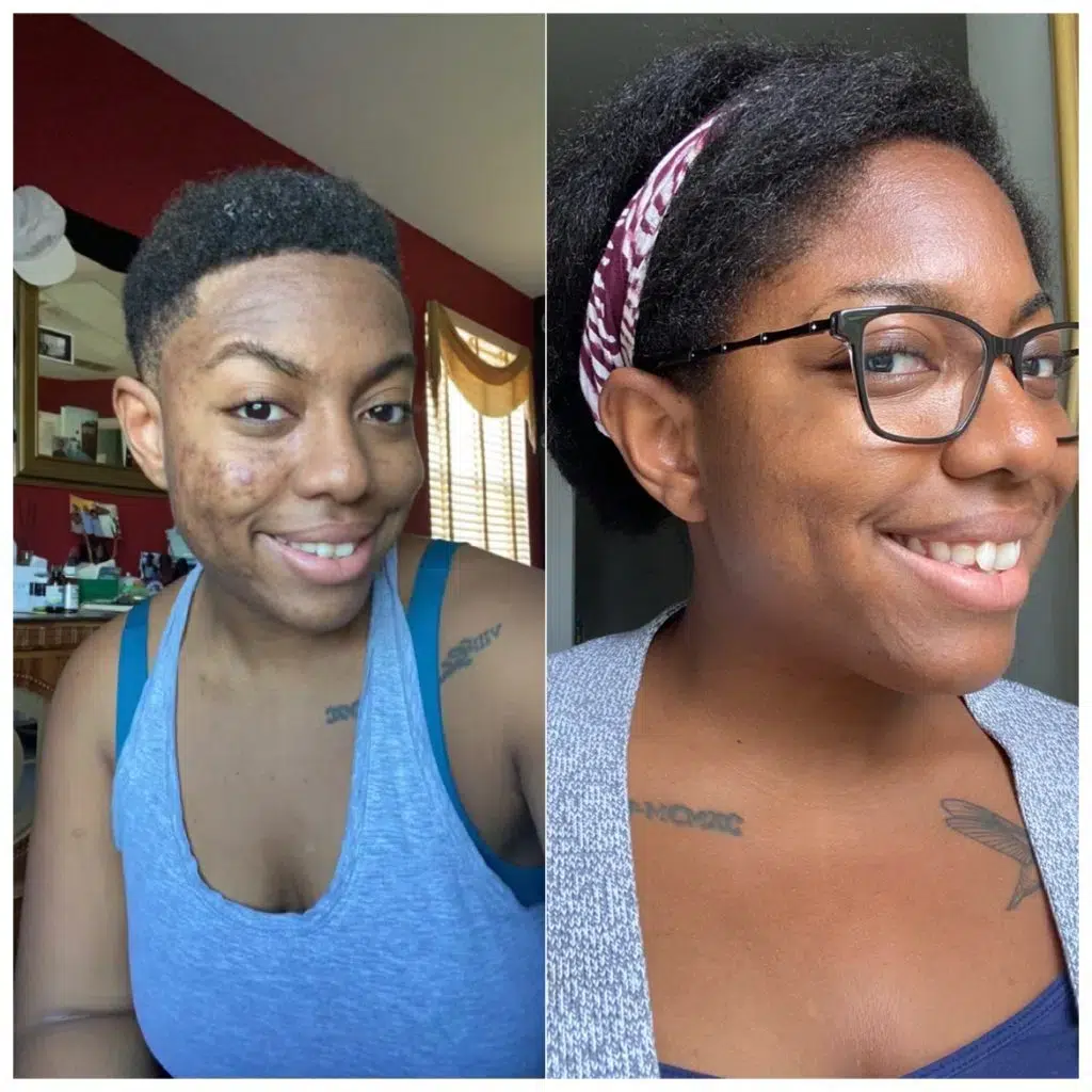 Acne focus skin program in Rittenhouse Square