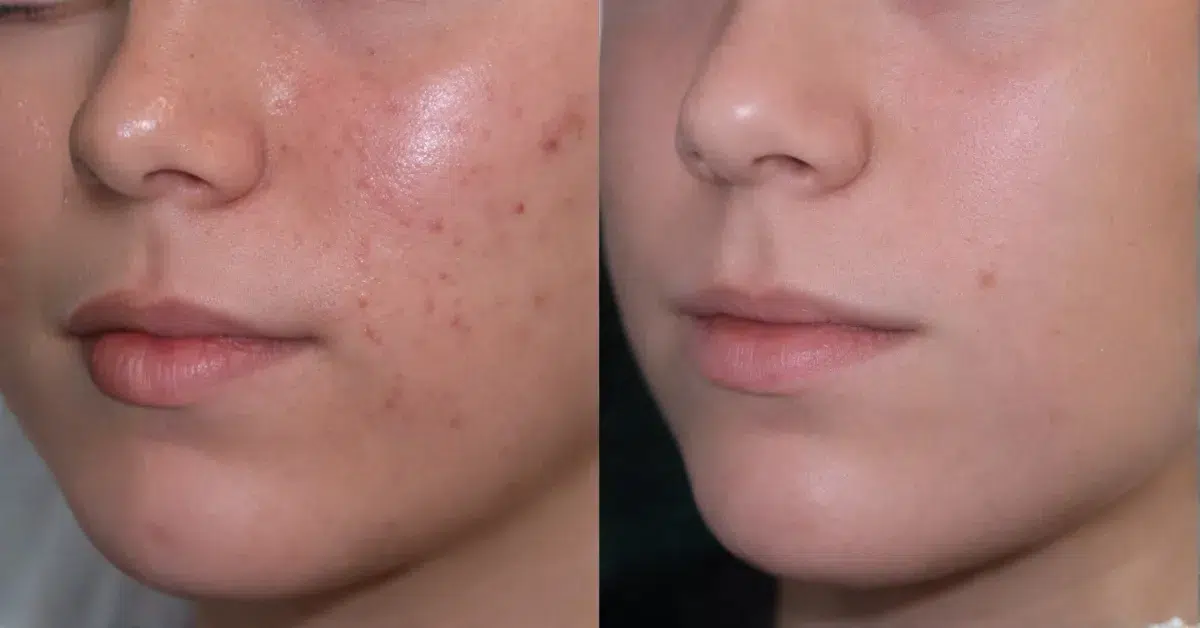 skincare treatment for acne and inflammation Philadelphia