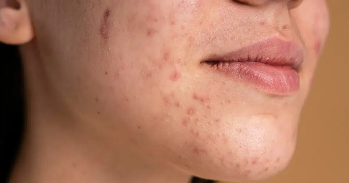 Professional skincare treatment for hormonal acne and clogged pores